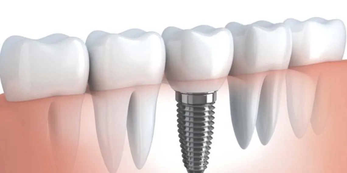 Impianto dentale dott ssa Verrua